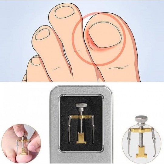 Aplikator za ispravljanje uraslih noktiju - Onycho Correct