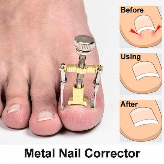 Aplikator za ispravljanje uraslih noktiju - Onycho Correct